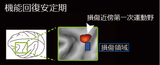 機能回復後数カ月経過した安定期のPET画像の図