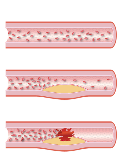 血管のアテローム性動脈硬化が進行する３つの図