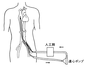 補助循環ポンプの使用例の図