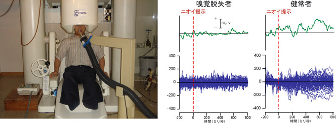 脳磁波の計測写真、嗅覚脱失者の脳波・脳磁波と健常者の脳波・脳磁波の図