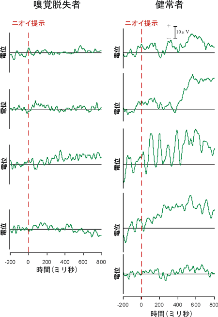 4名の嗅覚脱失者の脳波と、5名の健常者の脳波の図
