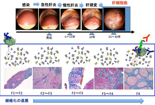 がんに向かう肝炎の進行度の説明図