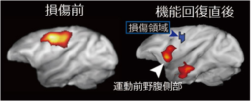 脳損傷前（左）と機能回復直後（右）のPET画像の図