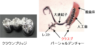 人工歯（補綴修復物）の説明図